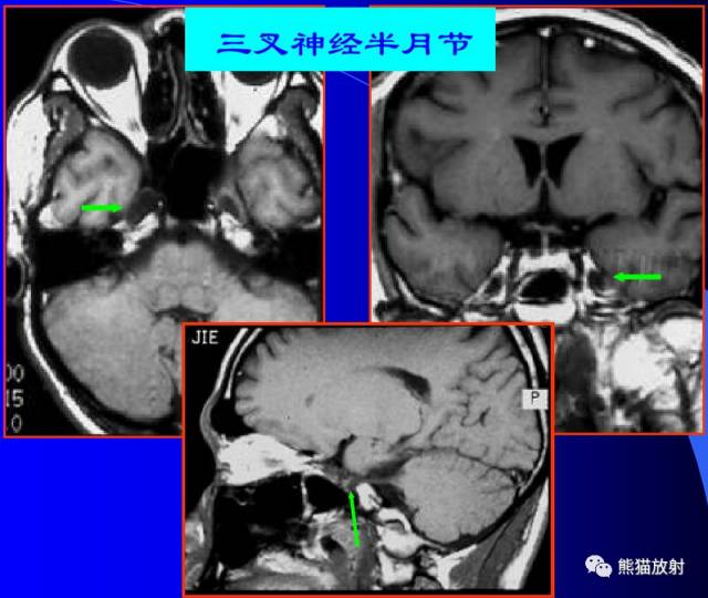 脑神经MRI断层解剖 脑神经MRI断层解剖