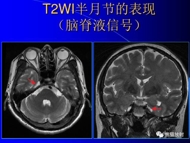 脑神经MRI断层解剖 脑神经MRI断层解剖