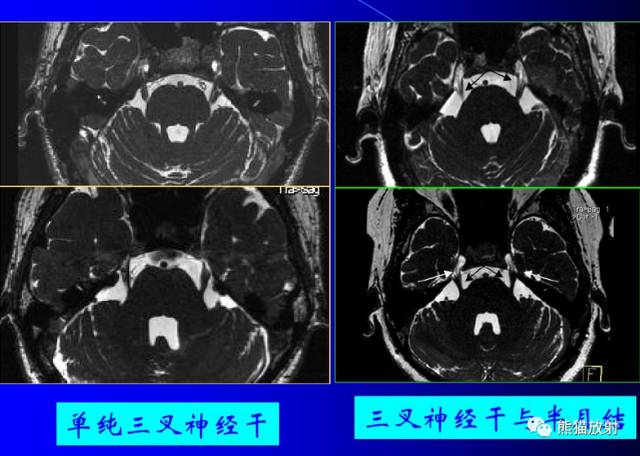 脑神经MRI断层解剖 脑神经MRI断层解剖