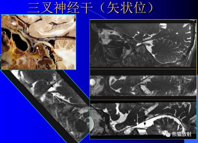 脑神经MRI断层解剖 脑神经MRI断层解剖