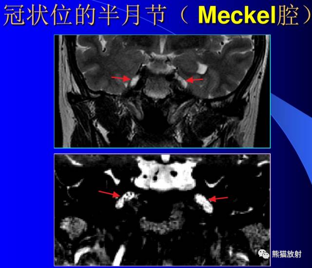 脑神经MRI断层解剖 脑神经MRI断层解剖