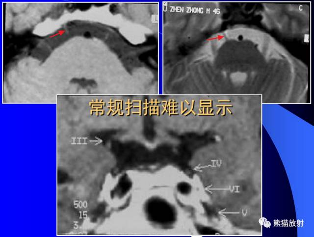 脑神经MRI断层解剖 脑神经MRI断层解剖