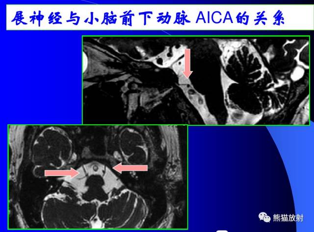 脑神经MRI断层解剖 脑神经MRI断层解剖