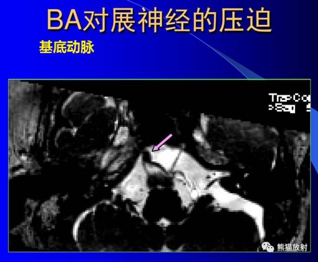 脑神经MRI断层解剖 脑神经MRI断层解剖