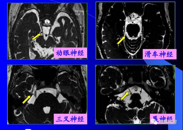 脑神经MRI断层解剖 脑神经MRI断层解剖