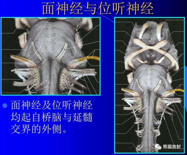 脑神经MRI断层解剖 脑神经MRI断层解剖