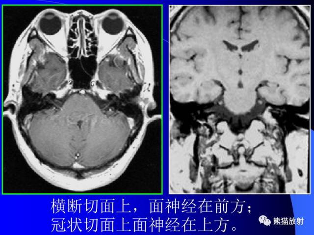 脑神经MRI断层解剖 脑神经MRI断层解剖