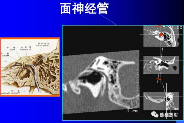 脑神经MRI断层解剖 脑神经MRI断层解剖