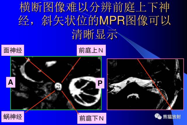 脑神经MRI断层解剖 脑神经MRI断层解剖