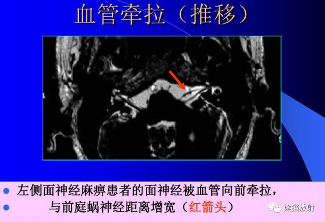 脑神经MRI断层解剖 脑神经MRI断层解剖