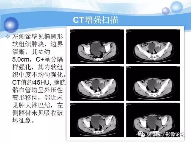 【病例】腹膜后梭形细胞瘤VS神经鞘瘤各1例CT及MR