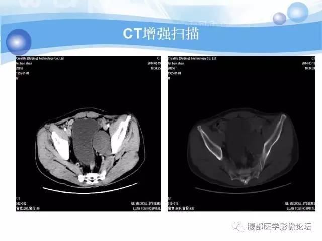 【病例】腹膜后梭形细胞瘤VS神经鞘瘤各1例CT及MR