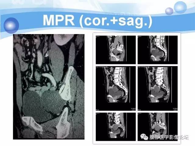 【病例】腹膜后梭形细胞瘤VS神经鞘瘤各1例CT及MR