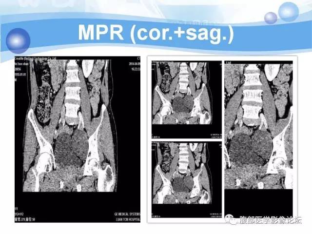 【病例】腹膜后梭形细胞瘤VS神经鞘瘤各1例CT及MR