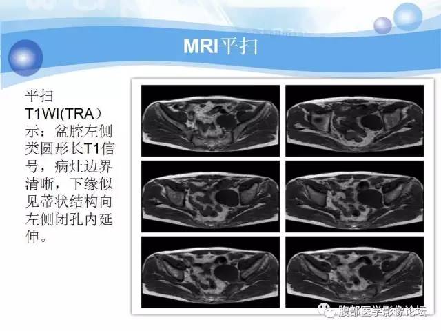 【病例】腹膜后梭形细胞瘤VS神经鞘瘤各1例CT及MR
