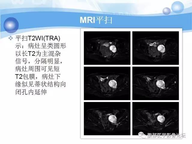 【病例】腹膜后梭形细胞瘤VS神经鞘瘤各1例CT及MR