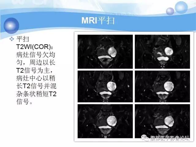 【病例】腹膜后梭形细胞瘤VS神经鞘瘤各1例CT及MR