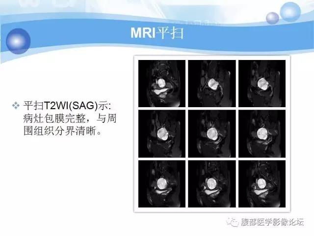 【病例】腹膜后梭形细胞瘤VS神经鞘瘤各1例CT及MR