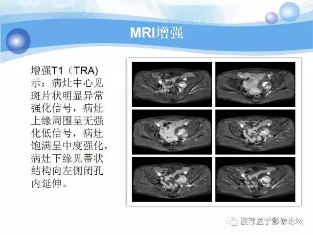 【病例】腹膜后梭形细胞瘤VS神经鞘瘤各1例CT及MR