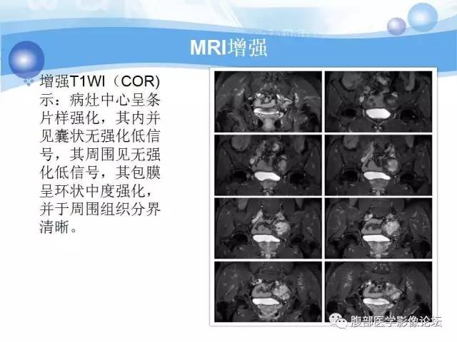 【病例】腹膜后梭形细胞瘤VS神经鞘瘤各1例CT及MR
