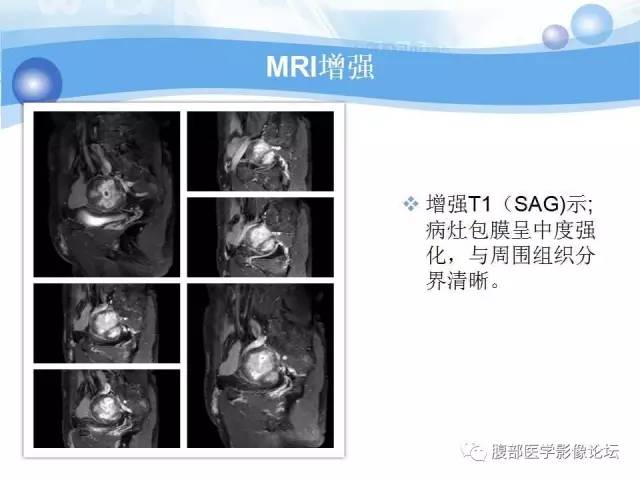 【病例】腹膜后梭形细胞瘤VS神经鞘瘤各1例CT及MR