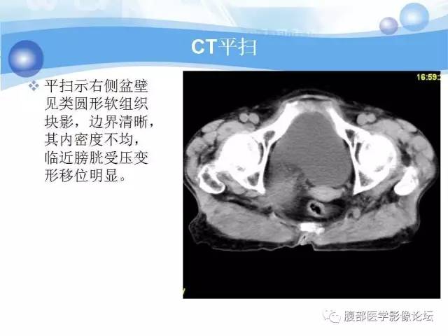 【病例】腹膜后梭形细胞瘤VS神经鞘瘤各1例CT及MR