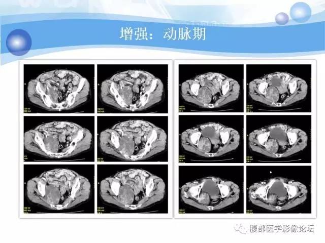【病例】腹膜后梭形细胞瘤VS神经鞘瘤各1例CT及MR