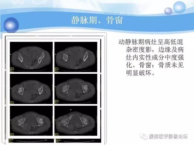 【病例】腹膜后梭形细胞瘤VS神经鞘瘤各1例CT及MR