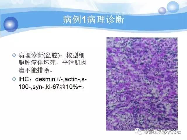【病例】腹膜后梭形细胞瘤VS神经鞘瘤各1例CT及MR