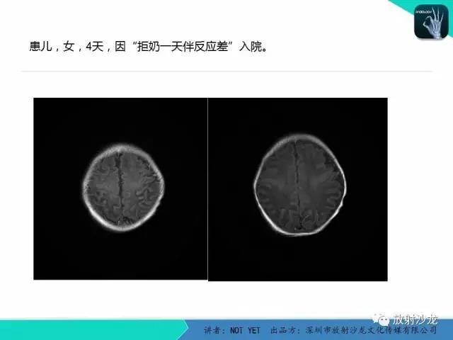 【病例】新生儿低血糖脑病1例MR影像表现