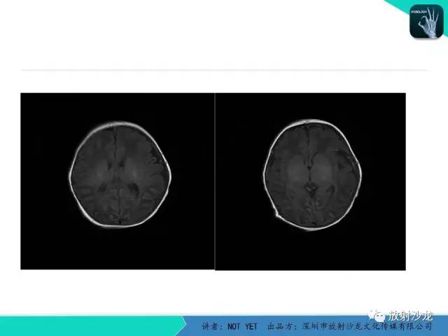 【病例】新生儿低血糖脑病1例MR影像表现