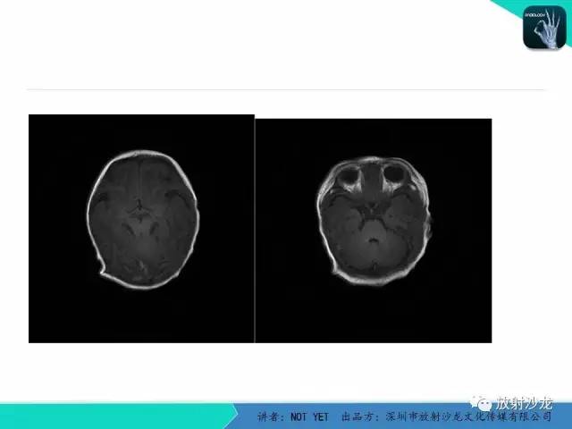 【病例】新生儿低血糖脑病1例MR影像表现