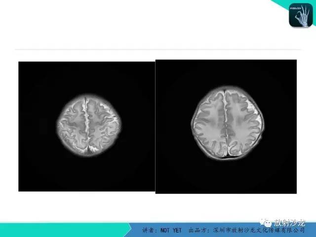 【病例】新生儿低血糖脑病1例MR影像表现