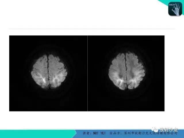 【病例】新生儿低血糖脑病1例MR影像表现