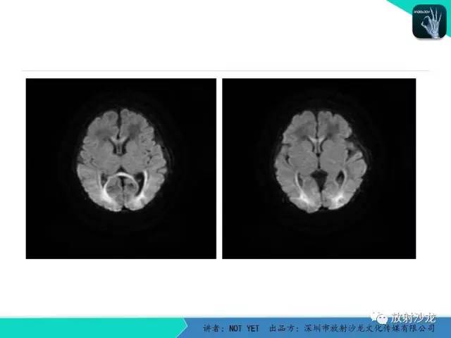 【病例】新生儿低血糖脑病1例MR影像表现