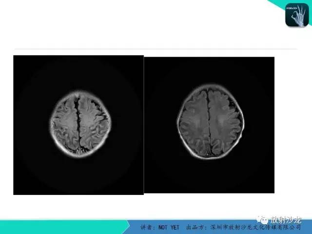 【病例】新生儿低血糖脑病1例MR影像表现