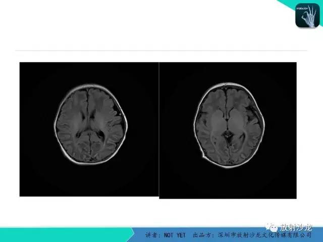 【病例】新生儿低血糖脑病1例MR影像表现