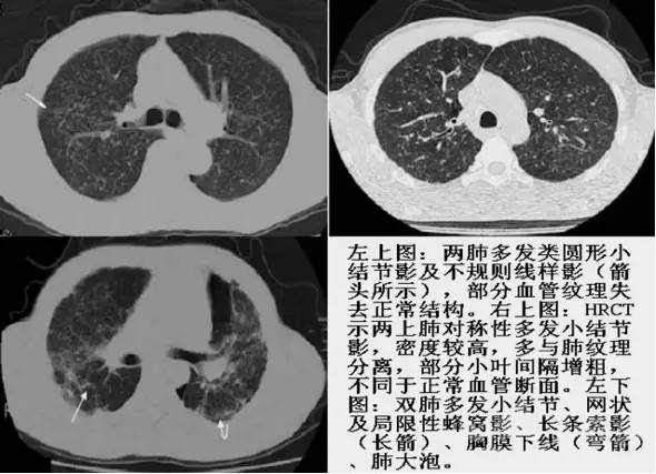 转移性肺癌CT表现特点大盘点 转移性肺癌CT表现特点大盘点
