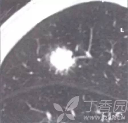 转移性肺癌CT表现特点大盘点 转移性肺癌CT表现特点大盘点