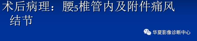 【病例】腰椎痛风1例CT影像表现