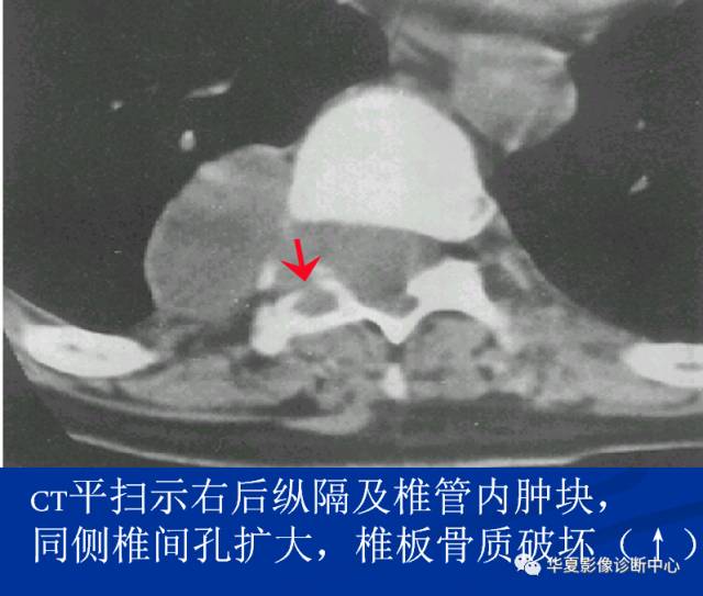 【病例】腰椎痛风1例CT影像表现