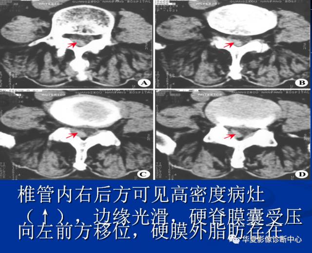 【病例】腰椎痛风1例CT影像表现