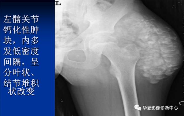 【病例】腰椎痛风1例CT影像表现