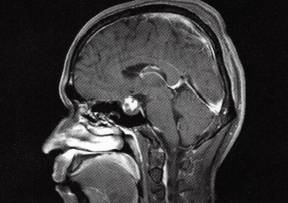 【病例】鞍区血管平滑肌瘤1例MR影像解读 【病例】鞍区血管平滑肌瘤1例MR影像解读