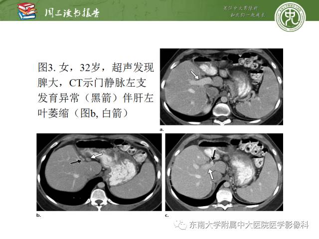 【PPT】肝脏血管性病变影像学表现【RG精选】