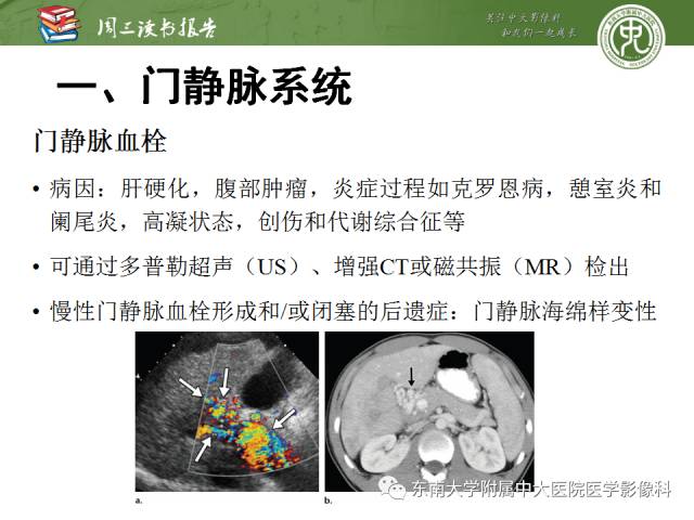 【PPT】肝脏血管性病变影像学表现【RG精选】