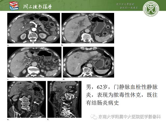 【PPT】肝脏血管性病变影像学表现【RG精选】