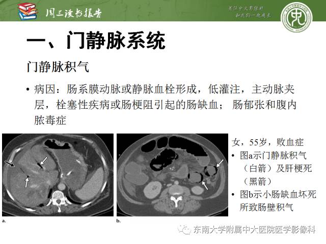 【PPT】肝脏血管性病变影像学表现【RG精选】