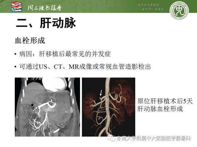 【PPT】肝脏血管性病变影像学表现【RG精选】
