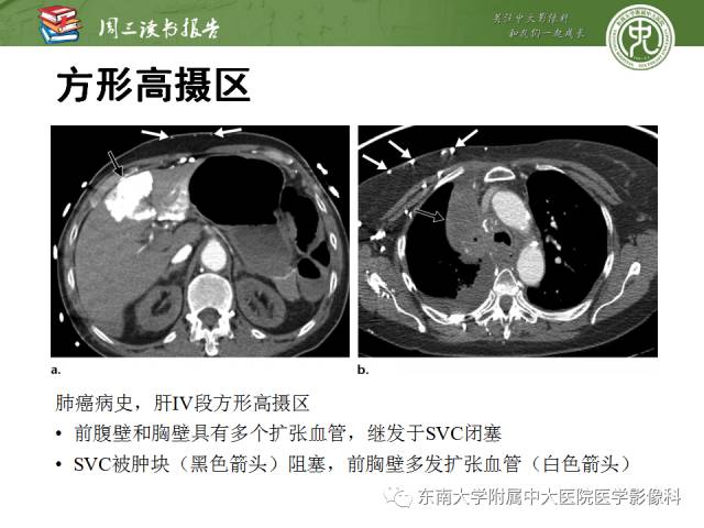 【PPT】肝脏血管性病变影像学表现【RG精选】
